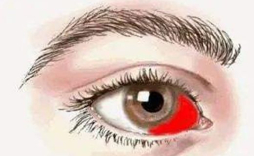 眼底出血的中医治疗