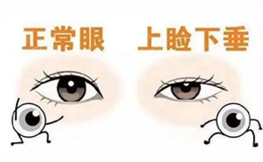 陈济东上睑下垂专题门诊介绍