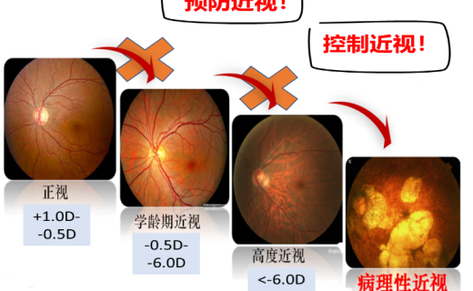  离焦框架眼镜控制儿童近视疗效及安全性的临床研究