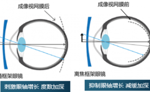 特殊设计框架镜临床研究，正在火爆预约中！