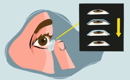 近视防控神器OK镜的佩戴和护理，你学会了吗？