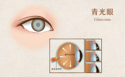 健康上海12320：为eye筑牢 “防护墙”，守护清晰视界丨世界青光眼日