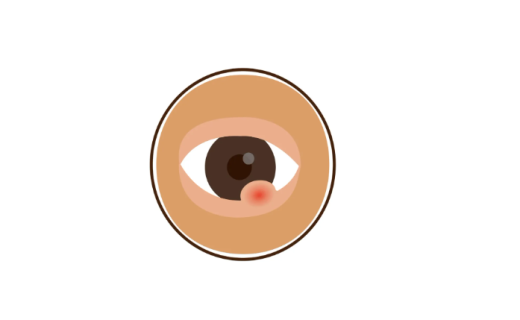 上海静安：大冷天火锅涮得太欢，眼睛偷偷“长痘”？医生：这不是巧合！